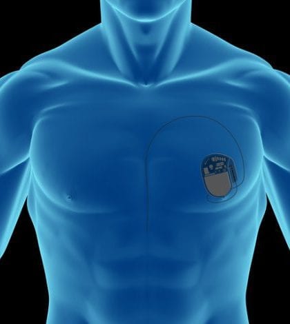 X-ray of a man, showing a pacemaker (for heart) on chest, on front view, great to be used in medicine works and health. Isolated on a black background.